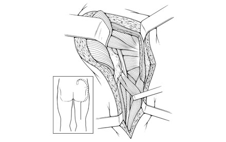Pen and Ink illustration of Sciatic opening