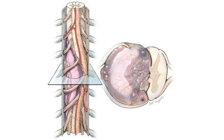 drawing of Myxopapillary ependymoma