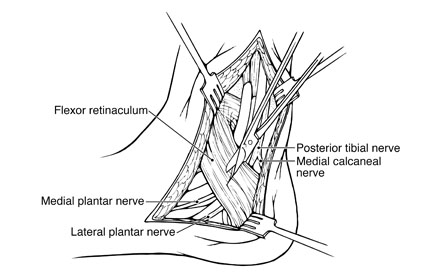 Pen and Ink illustration of Posterior tibial nerve opening