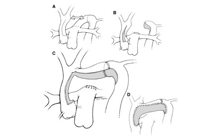 Pen and Ink illustration of Pediatric cardiovascular repair